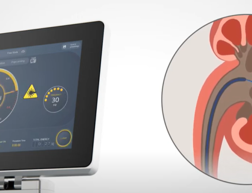 Νέο Laser TFL Drive στη Βιοκλινική Θεσσαλονίκης